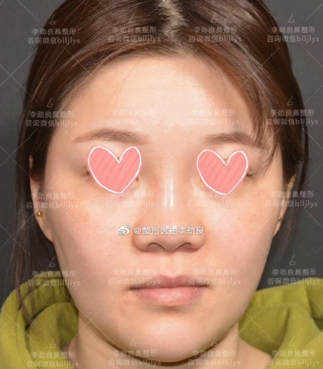 李勁良鼻修復(fù)案例