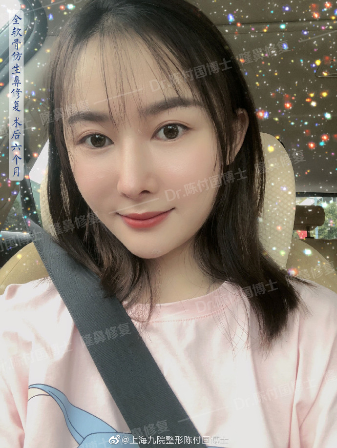 陳付國隆鼻案例