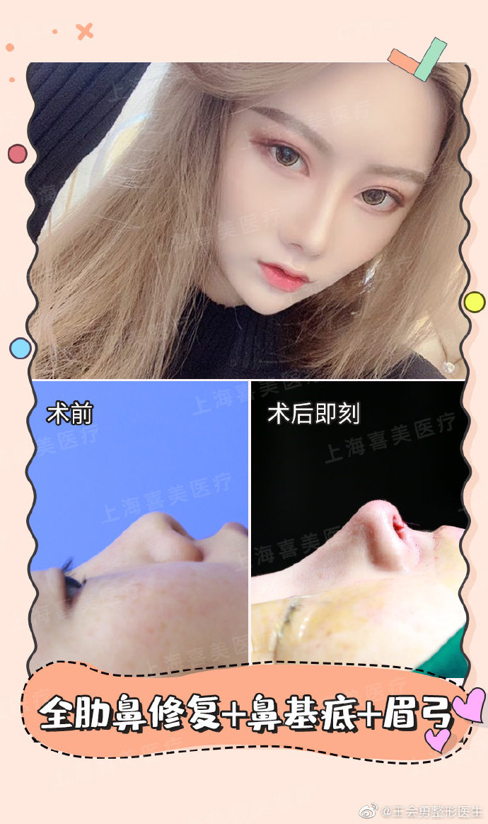 王會(huì)勇隆鼻案例