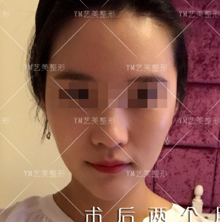 王東面部填充案例