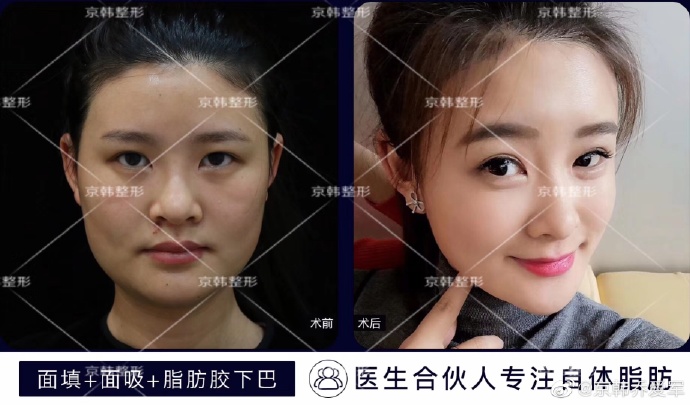 喬愛軍面部填充案例