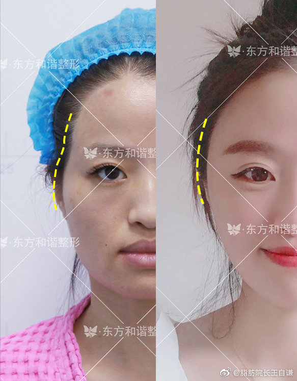 王自謙面部填充案例