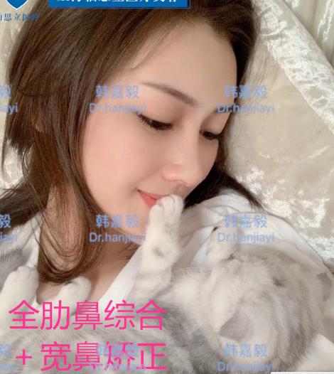 韓嘉毅鼻綜合案例