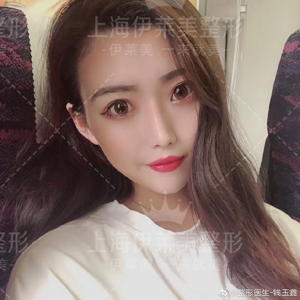 錢玉鑫鼻綜合案例