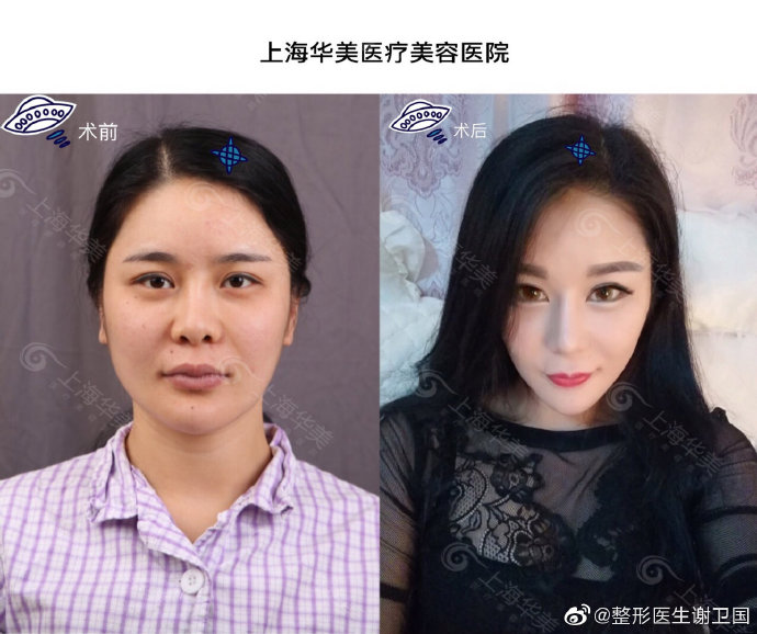 謝衛國鼻綜合案例