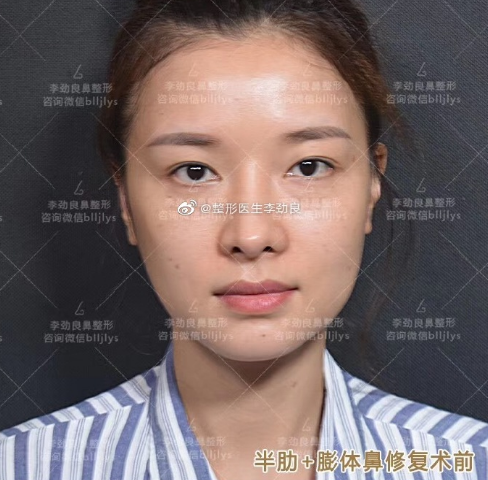 李勁良鼻修復案例