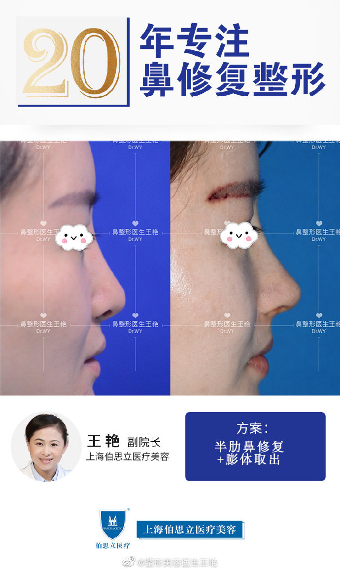 王艷鼻修復案例