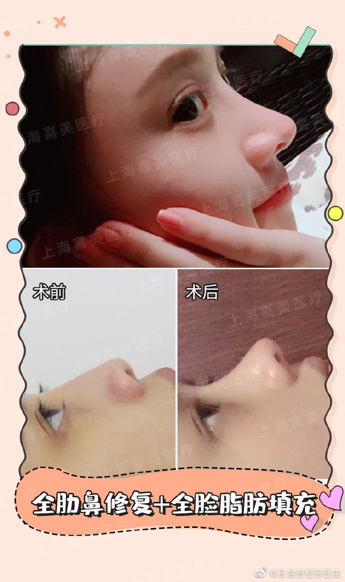 王會勇鼻修復案例