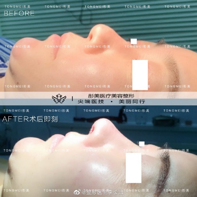 李長賦鼻綜合