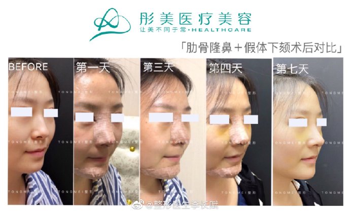 李長賦鼻綜合案例