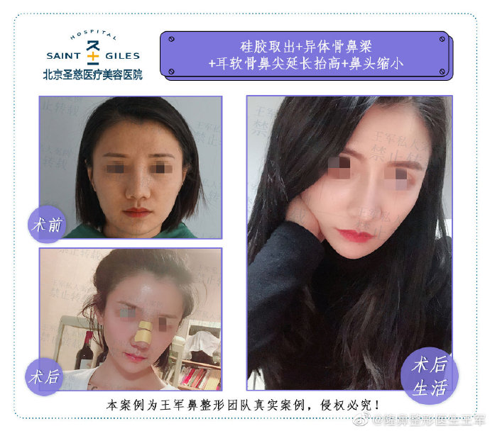 王軍鼻綜合案例