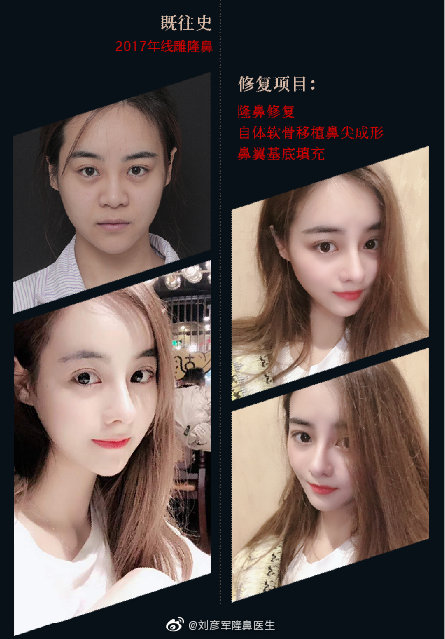 劉彥軍鼻綜合案例