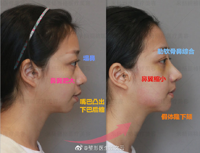 巫文云鼻綜合案例