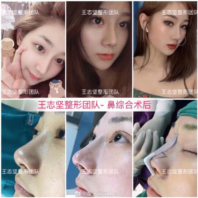 王志堅鼻綜合案例