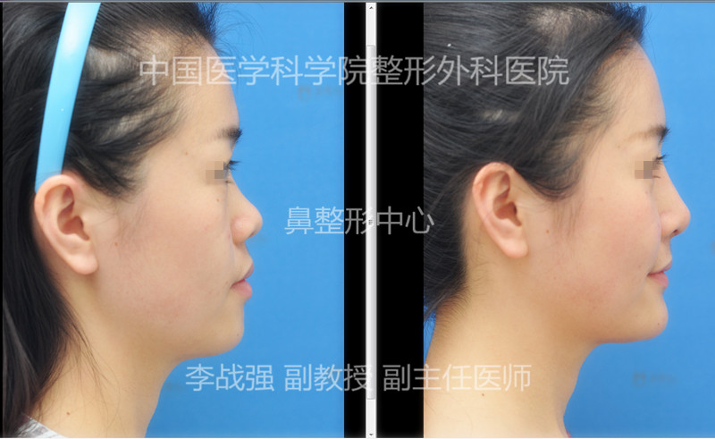 李戰強鼻修復案例
