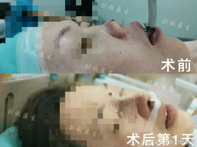 劉暾鼻修復案例