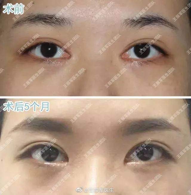 王振軍雙眼皮修復案例