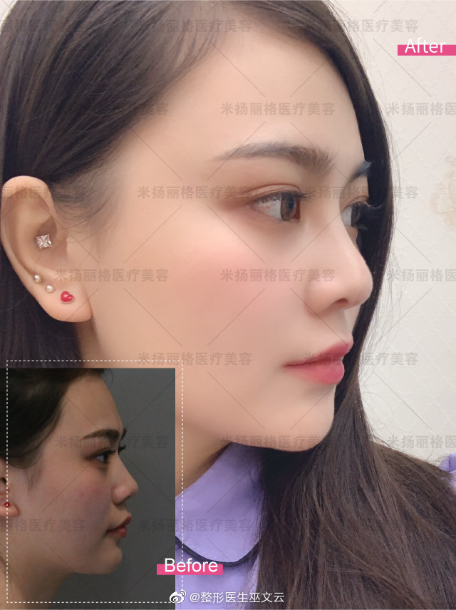 巫文云鼻修復(fù)案例
