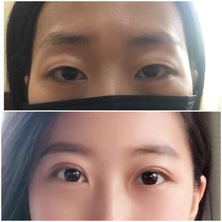 王世勇和田國靜哪個修復(fù)雙眼皮好？