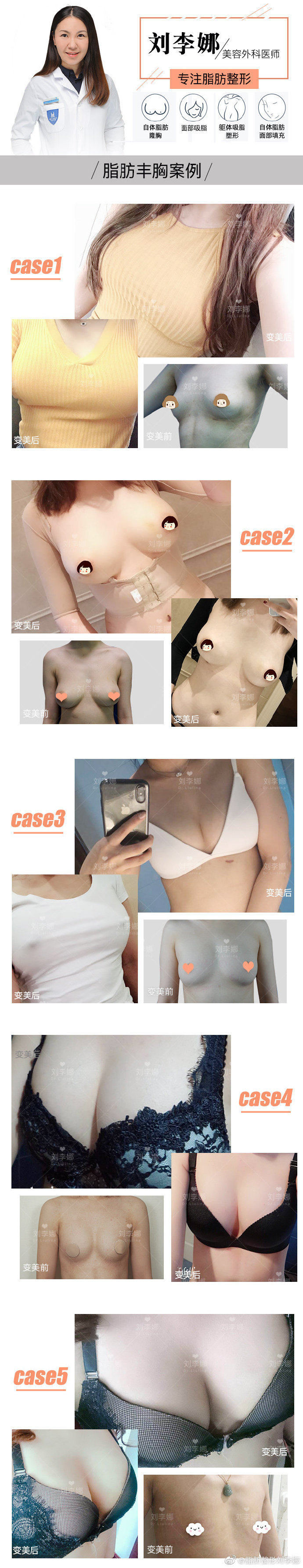 劉李娜脂肪豐胸案例