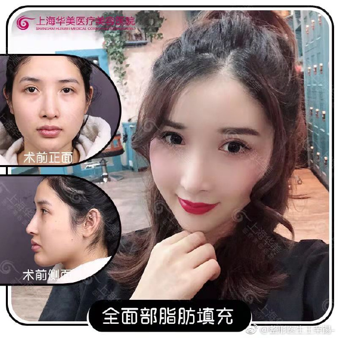 王榮錫面部填充