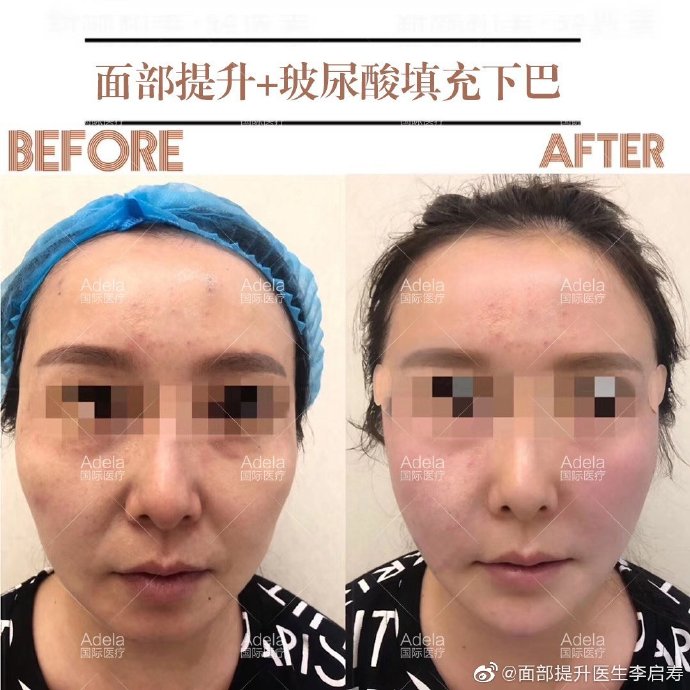 李啟壽面部提升案例