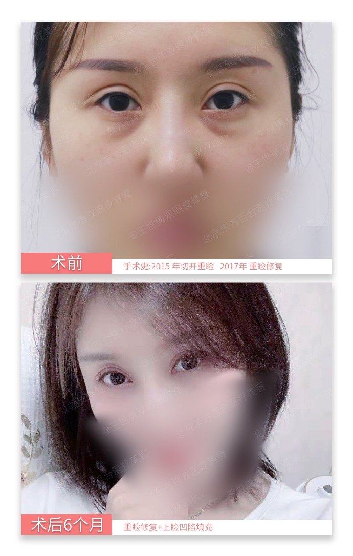 王世勇雙眼皮修復案例