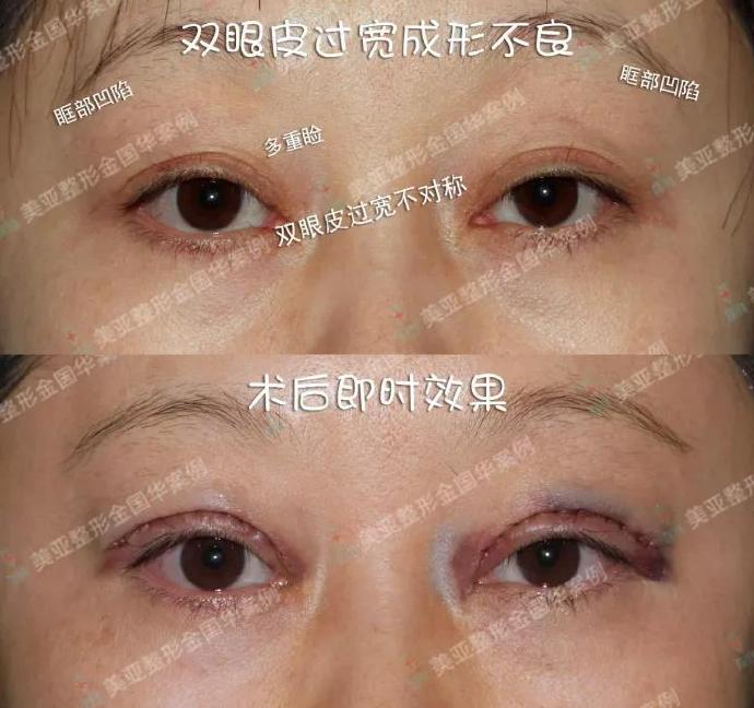 金國華雙眼皮修復案例