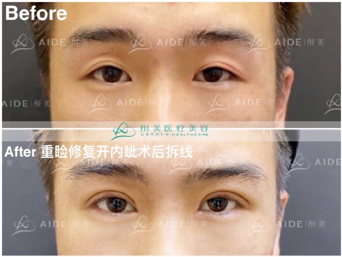 劉風卓雙眼皮修復案例