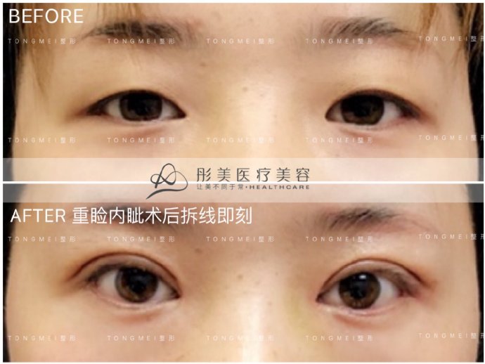 劉風卓雙眼皮案例
