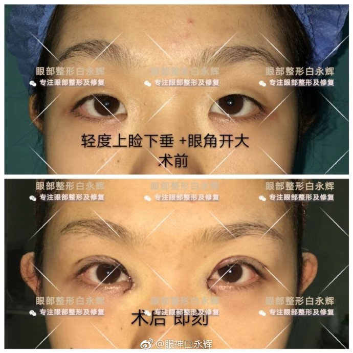 白永輝雙眼皮案例