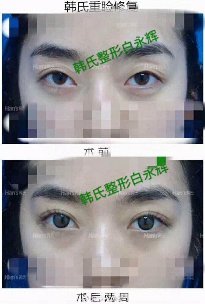 白永輝雙眼皮案例