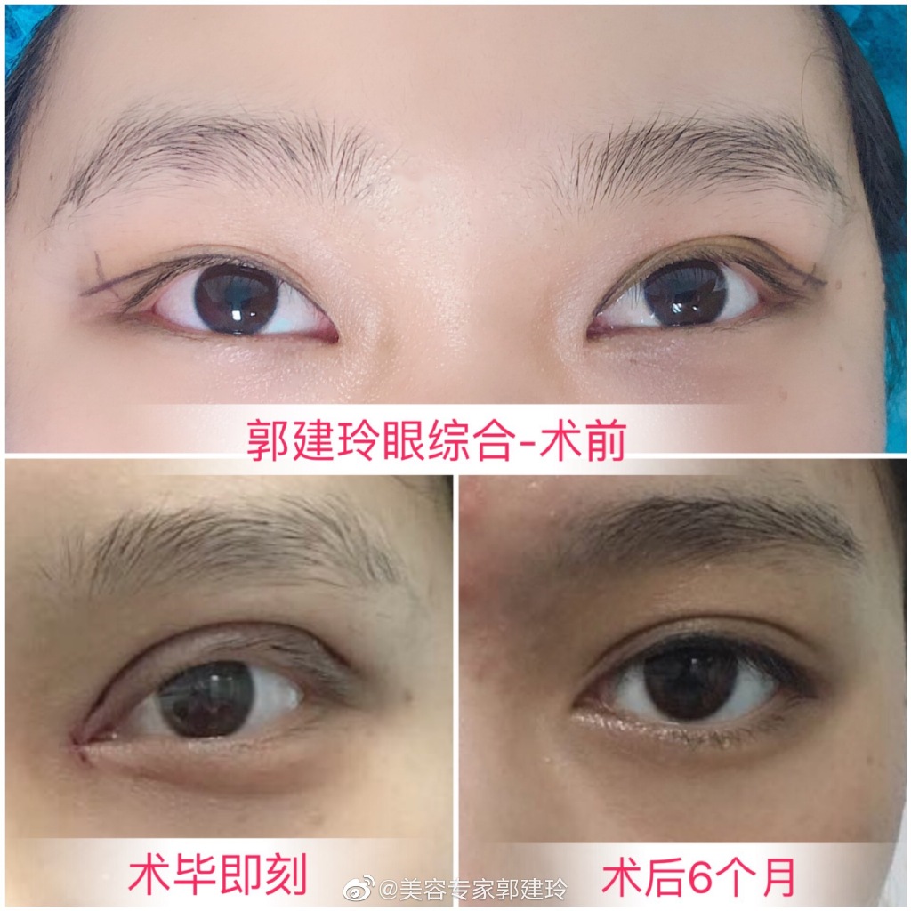 郭建玲眼綜合案例