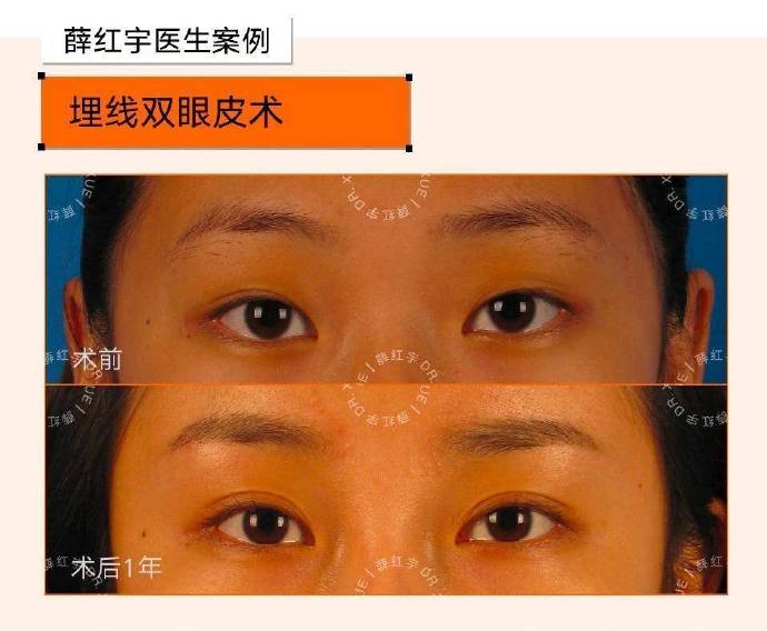 薛紅宇雙眼皮案例