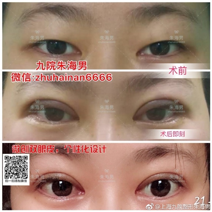 朱海男雙眼皮案例