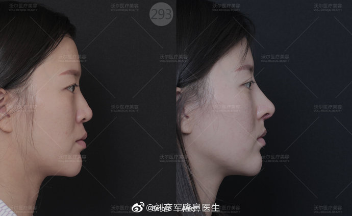 劉彥軍鼻綜合案例