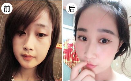 孫寶珊雙眼皮案例