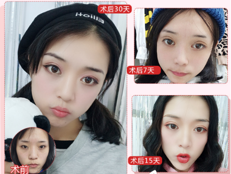 北京公立三甲醫院割雙眼皮醫生