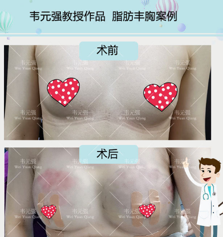 韋元強(qiáng)脂肪豐胸案例