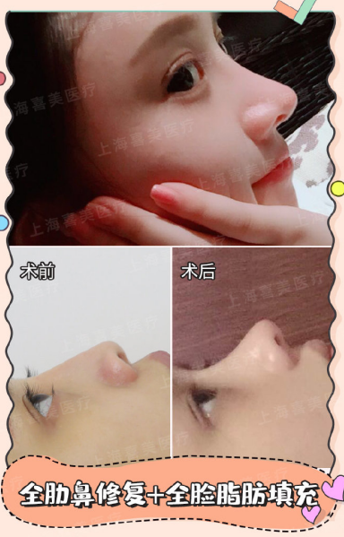 王會(huì)勇鼻修復(fù)案例