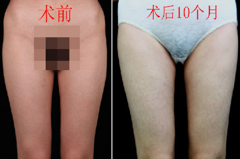 李發(fā)成吸脂案例