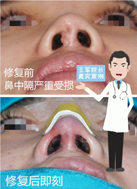 王軍鼻修復案例1