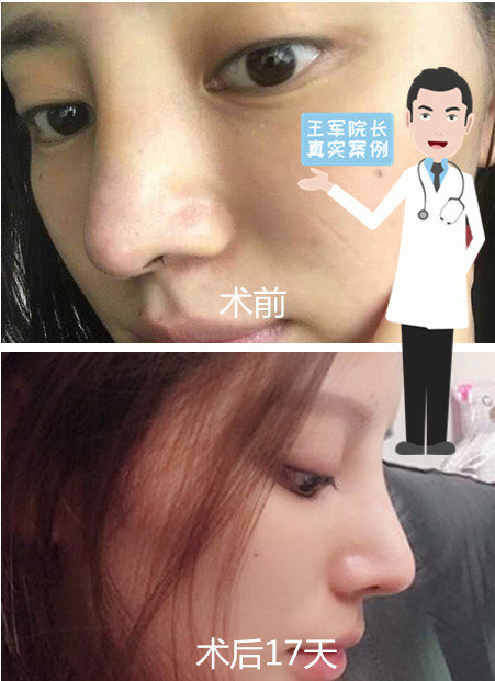 王軍鼻整形案例