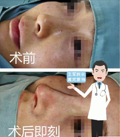 王軍鼻整形愛那里