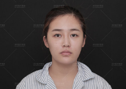 劉彥軍鼻整形案例
