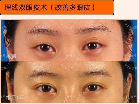 薛紅宇眼綜合案例
