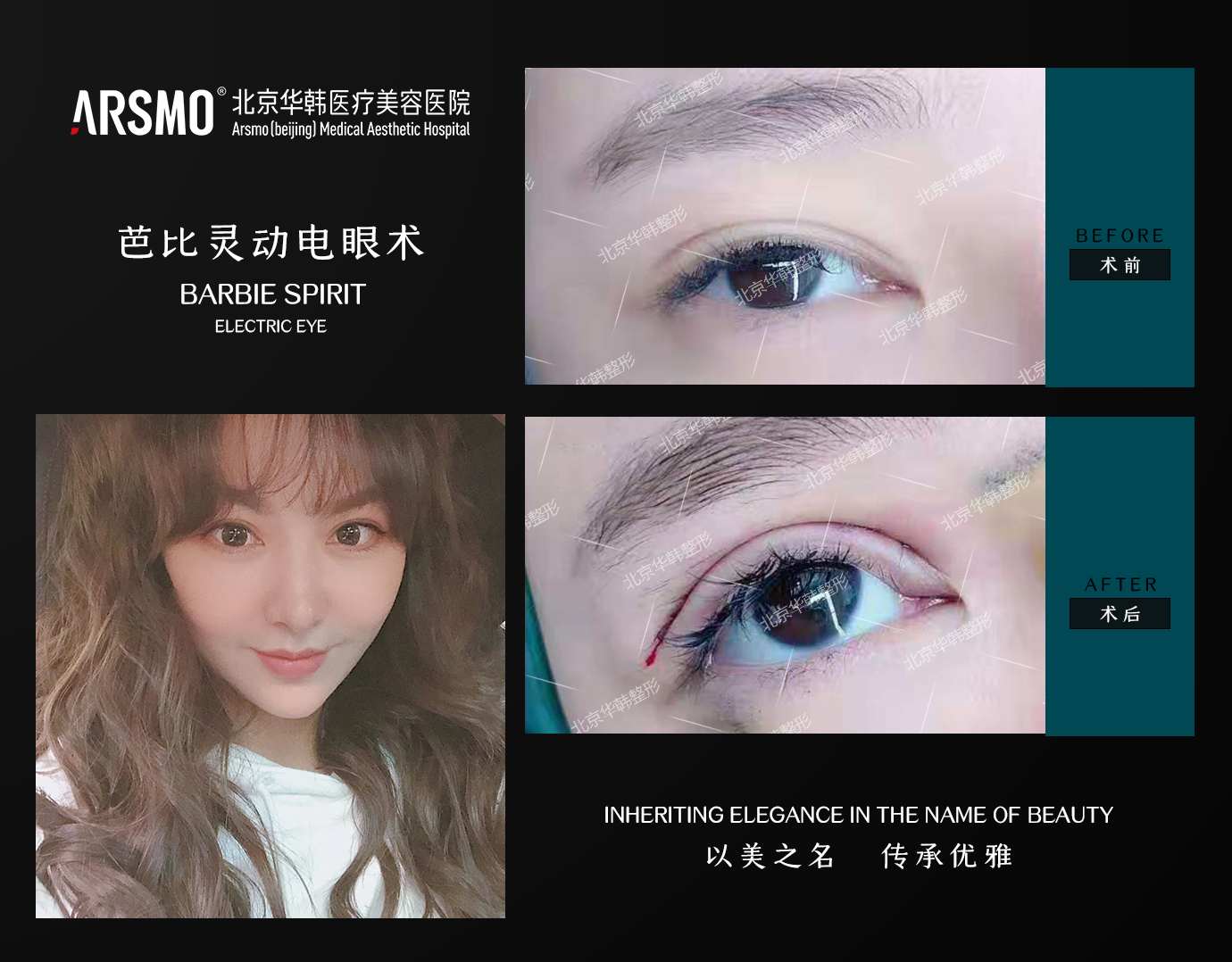 李鵬超眼綜合案例