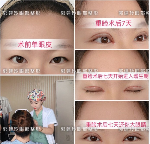 郭建玲眼綜合案例