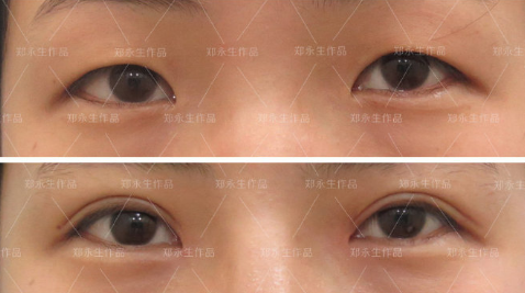 鄭永生眼綜合案例
