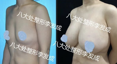 李發成豐胸案例